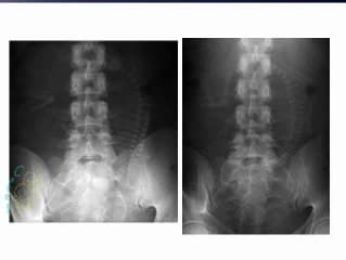 Dysplasie thoracique de Jeune