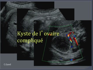 Masses intra-abdominales foetales