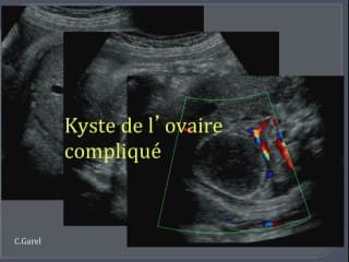Masses intra-abdominales foetales