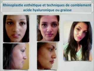 Fentes labio-palatines : images, diagnostics et thérapeutiques. Intérêt de la coupe axiale.