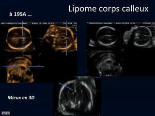 lipome du corps calleux