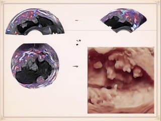 Cancérologie : et si l'échographie remplaçait l'IRM ? Cancer de l'endomètre