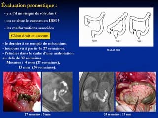 Malrotation et IRM : on avance