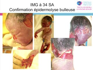 Place de l'échographie dans le diagnostic prénatal des anomalies de la peau foetale
