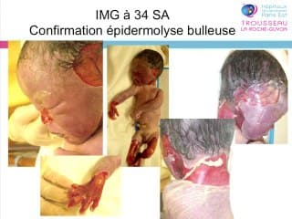 Place de l'échographie dans le diagnostic prénatal des anomalies de la peau foetale