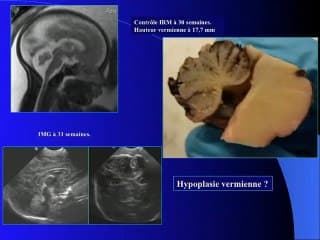 kyste de la poche de BLAKE