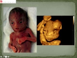 Syndrome de BARBER SAY, ablepharon macrostomia syndrome