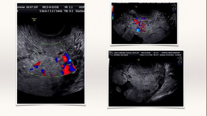 Placenta accreta