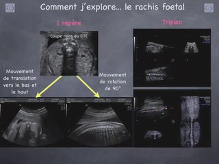 POSTER Rachis