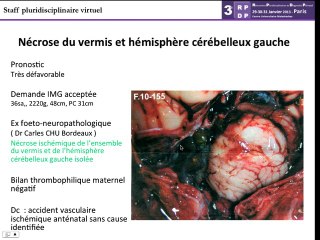 Anomalie de la fosse postérieure