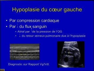 Hernie diaphragmatique : quel bilan échographique