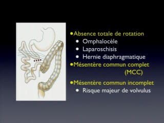 La malrotation en IRM : si le diagnostic est simplissime, l'évaluation pronostique est plus complexe.