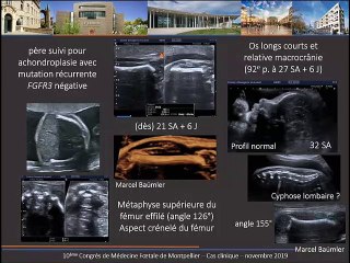 cas clinique :chondrodysplasie ponctuée téléphalangique