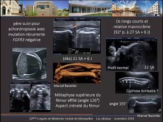 cas clinique :chondrodysplasie ponctuée téléphalangique