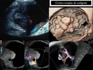 Critères échographiques de bénignité et de malignité des tumeurs de l’ovaire,apport de l’IRM, classifications