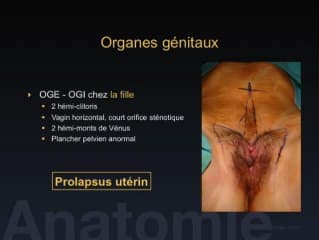 Exstrophie vésicale