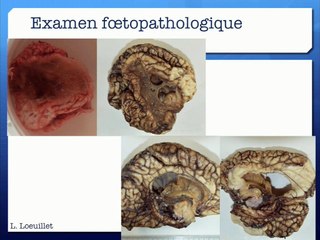 59 Diagnostic anténatal de déficit congénital en Facteur X: à propos d’un cas et revue de la littérature