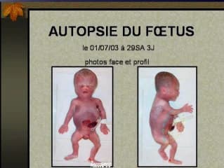 FFU syndrome (fémur fibula ulna syndrome)