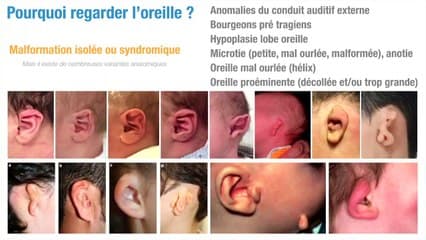 Examen de l’oreille : que peut-on attendre de l’échographiste ?