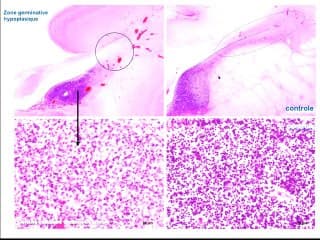 Récidive d'une microencéphalie : variant génétique ou nouvelle mutation ?