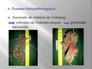 Calcifications péritonéales, peritonite méconiale et trisomie 21