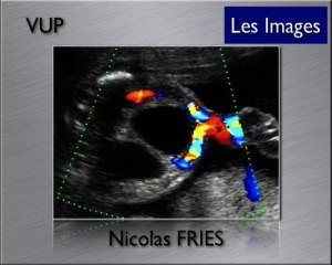 Grosse Vessie – VUP – Prune Belly – Mégavessie-microcôlon