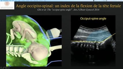 ÉCHOGRAPHIE EN SALLE DE TRAVAIL Apport de l’échographie au cours du travail et de l’accouchement