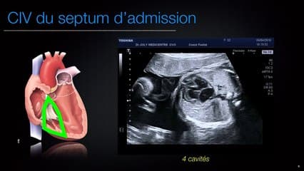 CIV Le point de vue du cardio-pédiatre