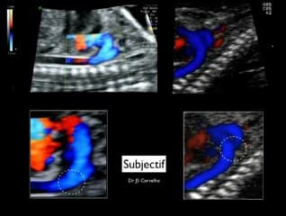 Le diagnostic prénatal des coarctations de l'aorte
