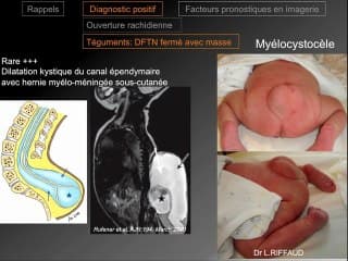 Imageries anténatales des spina bifida