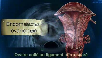 L’échographie dynamique pour le diagnostic de l’endométriose : et si l’IRM n’était plus le « gold standard »