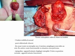 cas clinique : duplication vésicale
