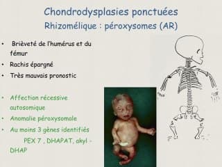 Hérédité et risque de récurrence des OCD.