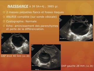 L’anté et le post natal des uropathies graves: pas toujours évident.
