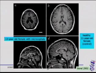 Les troubles de la gyration : le point de vue du généticien