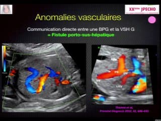 Examiner le foie, la rate et le pancréasL’aspect échographique normal, l’examen de dépistage et les signes pathologiques. Quelles conséquences pour les collègues périnatalogistes et les collègues chirurgiens pédiatriques ?