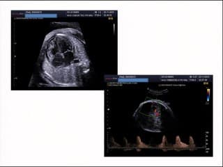 Néphropathies: cas clinique kyste para piélique