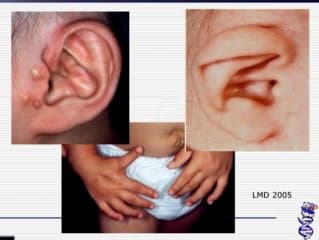 Syndromes polymalformatifs et malformations digestives