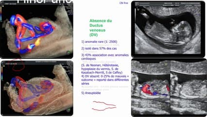 COEUR Le coeur au 1er trimestre