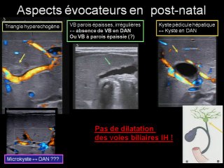 Diagnostic anténatal de l'atrésie des voies biliaires.