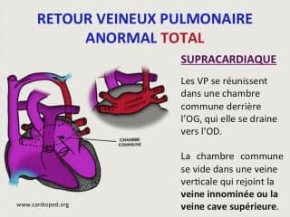 Cardiopathie de type RVPA