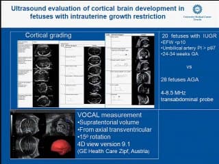 développement du cerveau foetal dans les RCIU  ( en ANGLAIS )