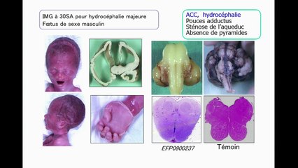 Anomalies du corps calleux : étude fœtopathologique et génétique d’une cohorte fœtale.