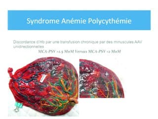 Injection du placenta des grossesses gémellaires monochoriales biamniotiques en postpartum. Intér't en dehors des syndromes anastomotiques