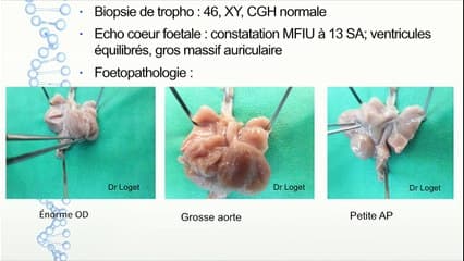 Intérêt d’une analyse fœto-pathologique et échographique précise au premier trimestre
