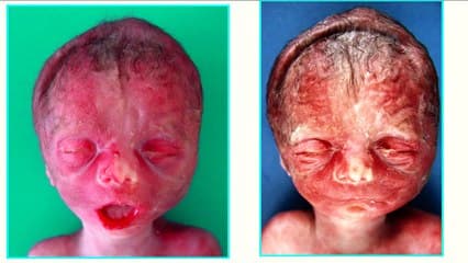 Corrélations Echographie-Foetopathologie : syndrome oro facio digital, chondrodysplasie ponctuée, syndrome de chonradi hunermann,