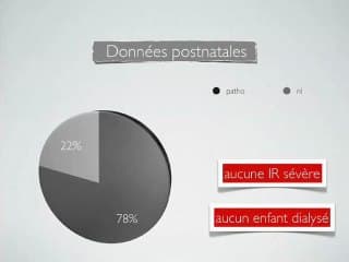 Devenir des fœtus porteurs de reins hyperéchogènes en anténatal - Étude rétrospective