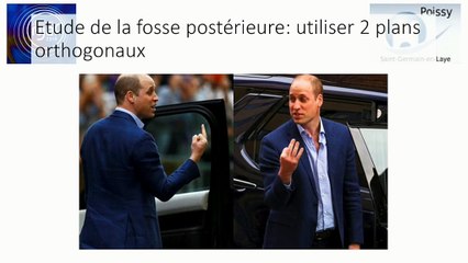 Cerveau foetal II : c’est trop gros ! Méga grande citerne