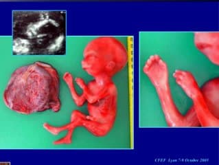 RCIU étiologies chromosomiques
