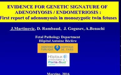 Adénomyose chez 2 foetus monozygotes : signature génétique pour l’adénomyose / l’endométriose ?